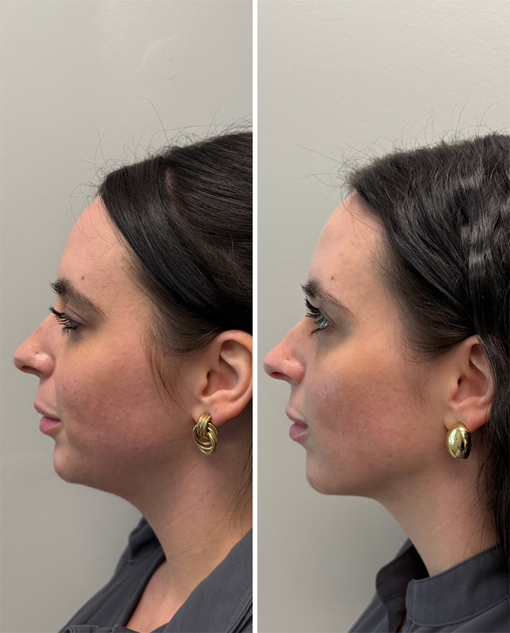 Jaw-Botox-BA-Dr