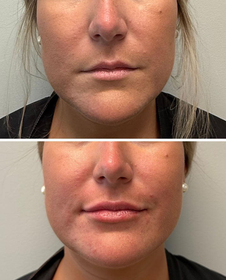 Lip Filler by Dr Caroline Savoie