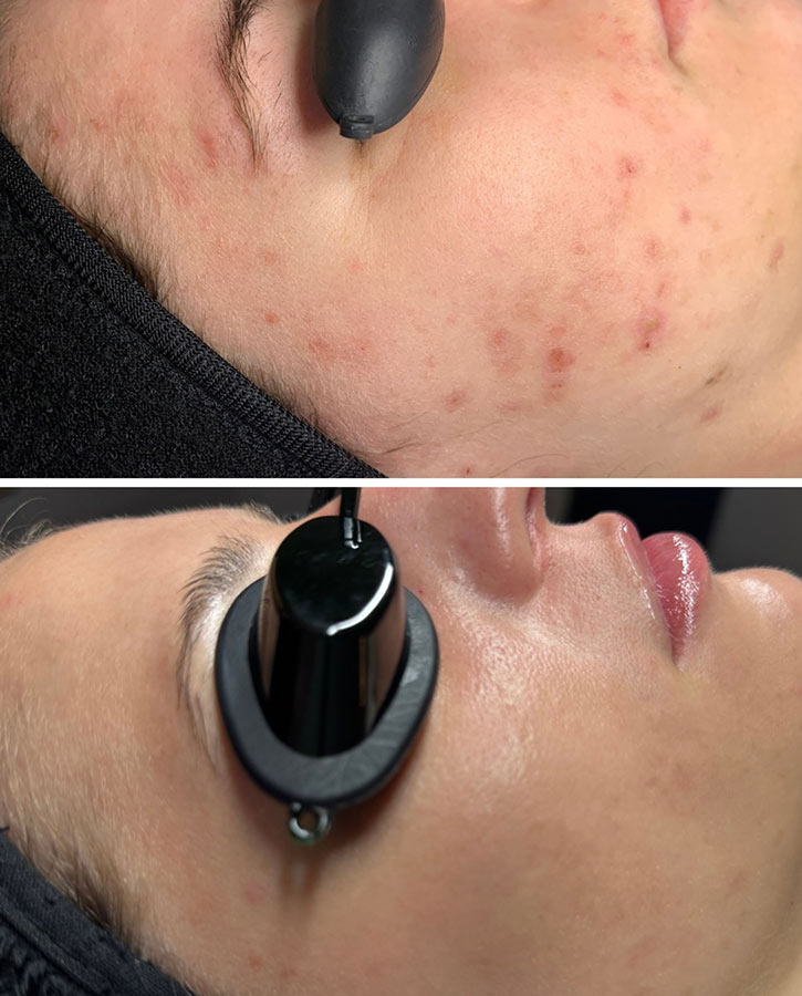 Series of SkinClear Treatments