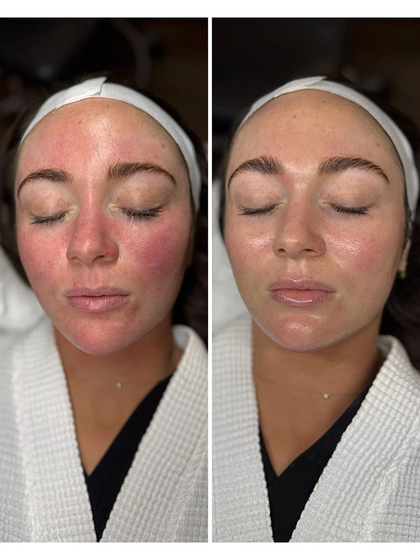 SkinSmooth+-with-CO2lift-mask-by-Giana-DiPietro-_before-and-after