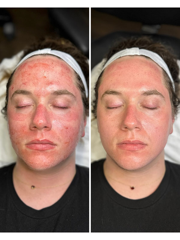 skinfirm-with-CO2-Lift-mask-by-Giana-DiPietro_before-and-after