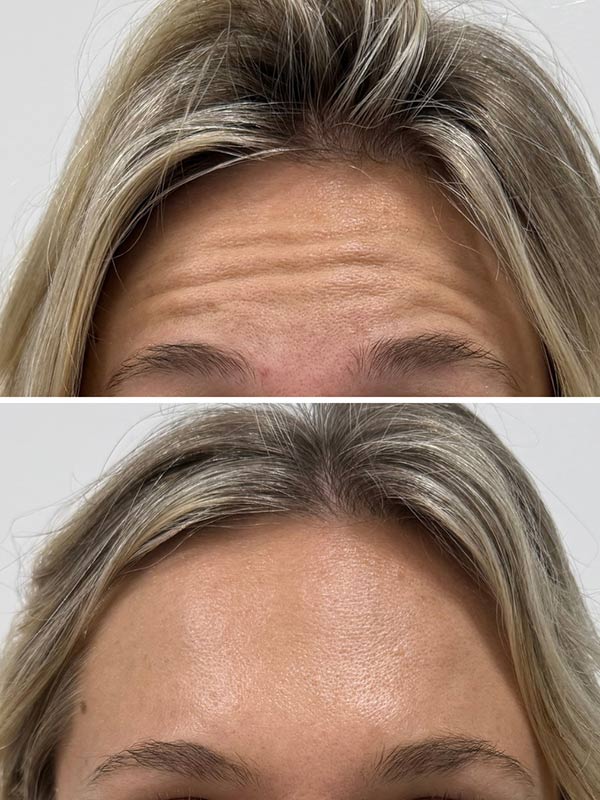 botox-b-a-Dr.-Savoie