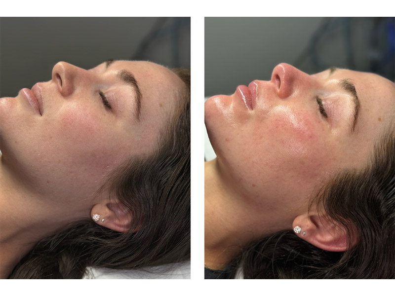 Before and After the treatment.